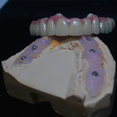 La personalizzazione adatta perfetta in nostre corone dell'impianto dentario
