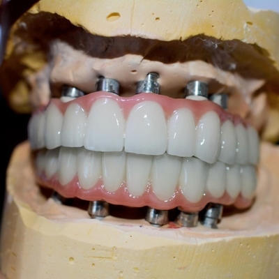 Il viaggio ad un sorriso sano il nostro processo della corona dell'impianto dentario