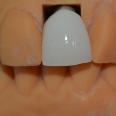 La forza dietro il nostro successo i nostri tecnici della corona dell'impianto dentario