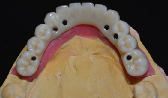 Elevando le norme la nostra assicurazione di qualità della corona dell'impianto dentario