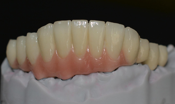 Abbracciando gli avanzamenti tecnologici il futuro delle corone dell'impianto dentario