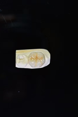 Longevità e durevolezza un investimento di vita con le nostre corone dentarie ceramiche