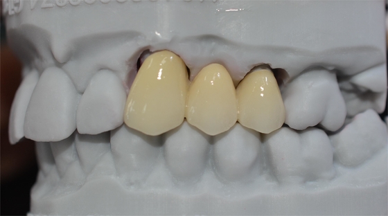 Longevità e durevolezza un investimento di vita con le nostre corone dentarie ceramiche