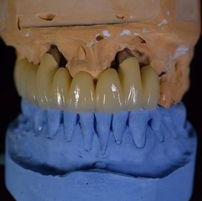 Forte trasparenza corona dentale in ceramica buona resistenza all'abrasione duratura
