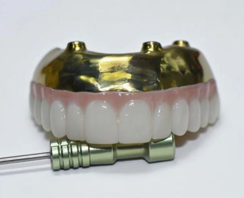 Ponte in zirconia completa con supporto in barra di titanio