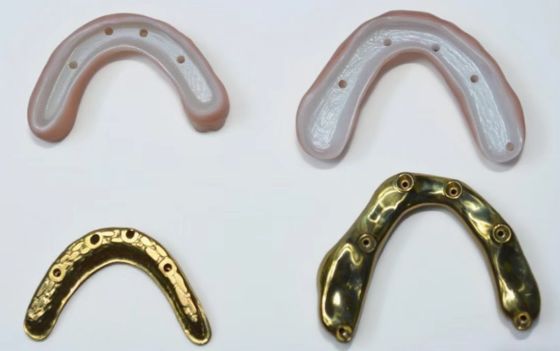 Ponte in zirconia completa con supporto in barra di titanio
