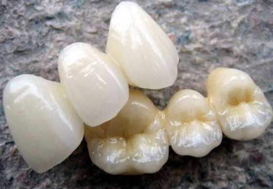 Alta porcellana della corona di biocompatibilità PFM fusa per ripristino dei denti posteriori