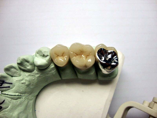 Alta porcellana della corona di biocompatibilità PFM fusa per ripristino dei denti posteriori
