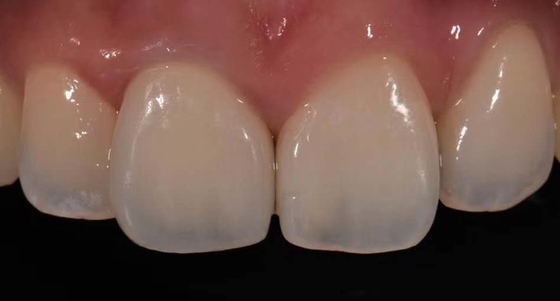 Alta porcellana della corona di biocompatibilità PFM fusa per ripristino dei denti posteriori