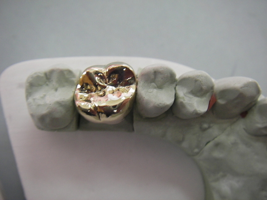 Materiale biologico alta tecnologia del metallo PFM del ponte dentario pieno della corona