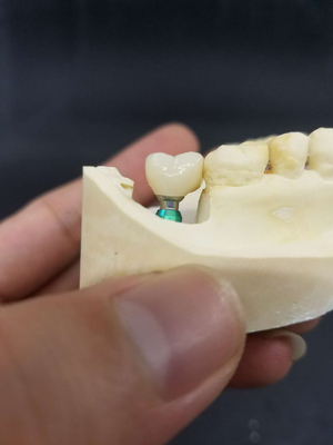 La corona biocompatibile di superficie liscia del dente di biossido di zirconio facile mantiene