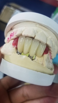 La corona biocompatibile di superficie liscia del dente di biossido di zirconio facile mantiene
