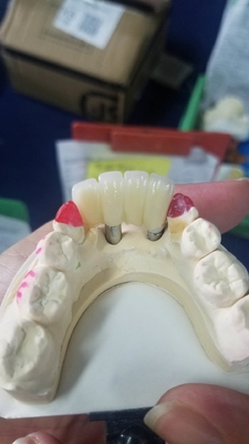 La corona biocompatibile di superficie liscia del dente di biossido di zirconio facile mantiene