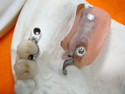 La protesi dentaria duratura del collegamento di precisione del laboratorio dentario macchia resistente