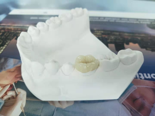 Parte sovrapposto in rilievo dentario Tutto ceramico durevole dell'intarsio dell'impiallacciatura della corona di FDA simile
