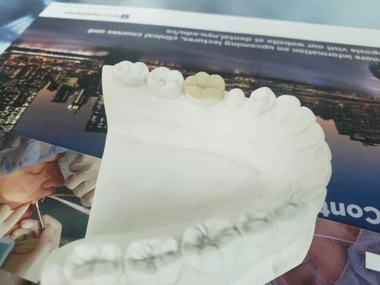 Parte sovrapposto in rilievo dentario Tutto ceramico durevole dell'intarsio dell'impiallacciatura della corona di FDA simile