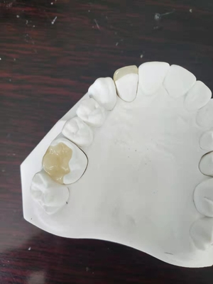 Parte sovrapposto in rilievo dentario Tutto ceramico durevole dell'intarsio dell'impiallacciatura della corona di FDA simile