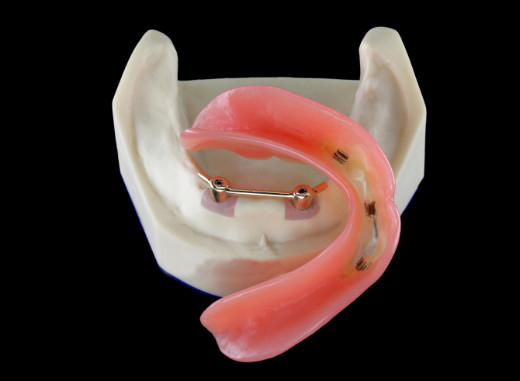 L'impianto di titanio di CNC All-On-4 ha fissato le protesi dentarie per la clinica dentaria