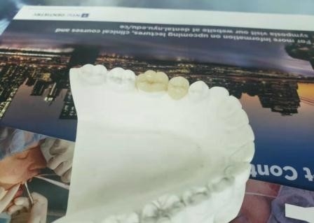 Corona flessibile durevole IPS dentario E Max Press Inlay Onlay del ponte di PFM