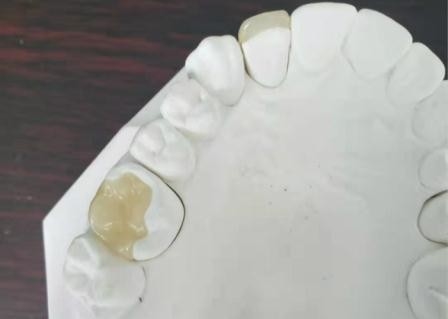 Corona flessibile durevole IPS dentario E Max Press Inlay Onlay del ponte di PFM