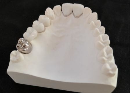 Resistenza della corrosione completa su misura del metallo della corona dentaria della porcellana di PFM
