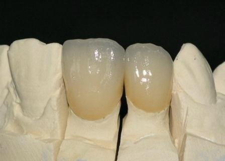 Corona metal-ceramica di superficie liscia di PFM resistente alla corrosione