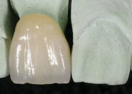 Corona metal-ceramica di superficie liscia di PFM resistente alla corrosione