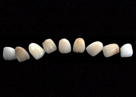 Corona metal-ceramica di superficie liscia di PFM resistente alla corrosione