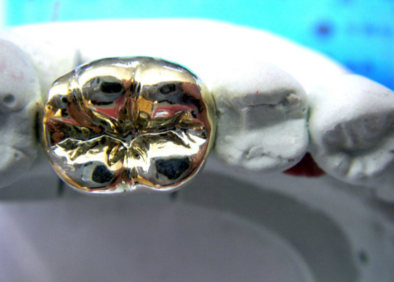 Colata facile dentaria preziosa del ponte PFM della corona degli alti semi di stabilità