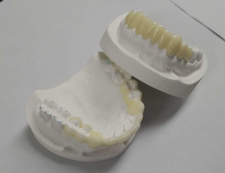 Stampa CAD CAM 3D ad alta durabilità Corone temporanee Resina durevole
