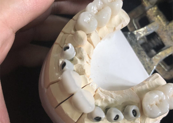 Biocompatibilità eccellente delle corone dentarie bianche libere di biossido di zirconio del metallo