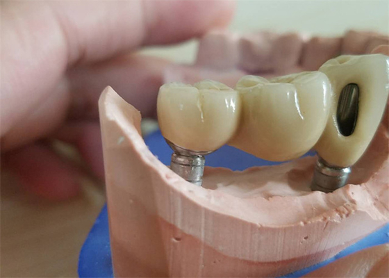 Corona dentaria di biossido di zirconio di camma di cad con l'appoggio basso di titanio di biossido di zirconio