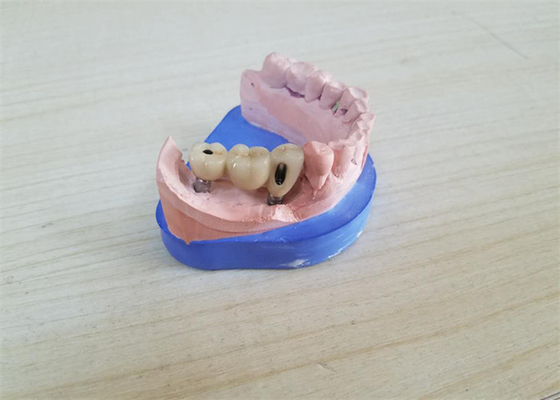 Corona dentaria di biossido di zirconio di camma di cad con l'appoggio basso di titanio di biossido di zirconio