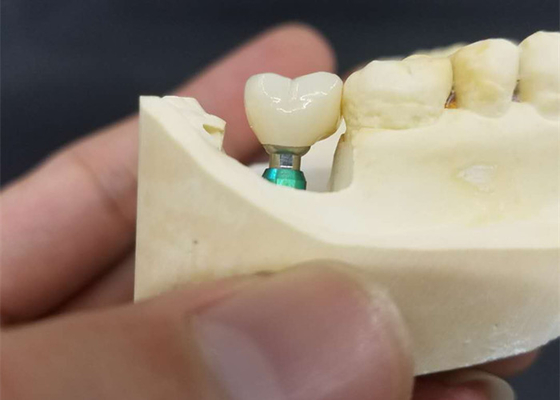 Colore ultra duro l'OEM che di stabilità la corona dell'impianto dentario facile mantiene