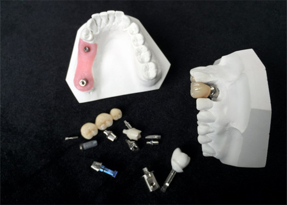 Alta corona dell'impianto dentario di biossido di zirconio di durevolezza per ripristino dentario