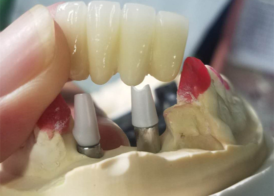 Forte base del Ti che macina il ponte di sostegno dente delle corone dell'impianto dentario