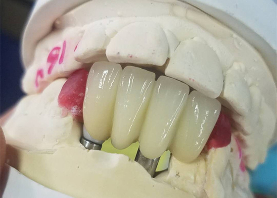 Forte base del Ti che macina il ponte di sostegno dente delle corone dell'impianto dentario