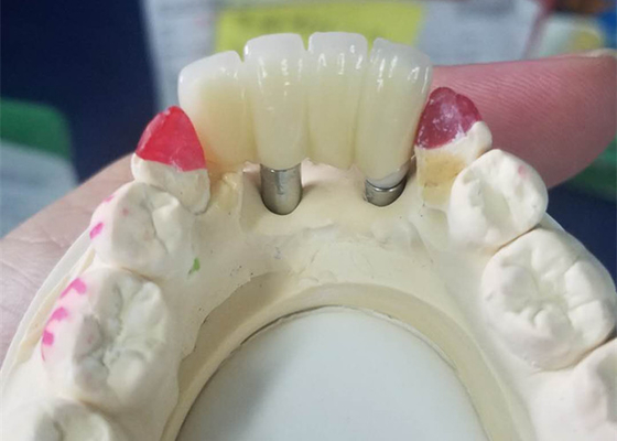Forte base del Ti che macina il ponte di sostegno dente delle corone dell'impianto dentario