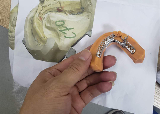 Il ponte dentario flessibile della corona di Digital PFM facile mantiene ultra duro