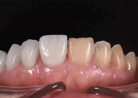 Corona dentaria ceramica d'imbiancatura di 0.3MM per sostituire i denti non sani