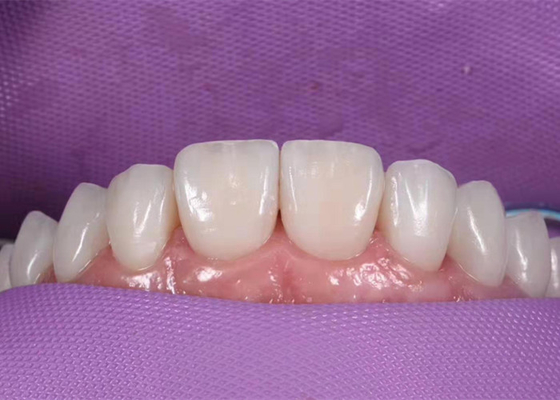 Corona dentaria ceramica d'imbiancatura di 0.3MM per sostituire i denti non sani