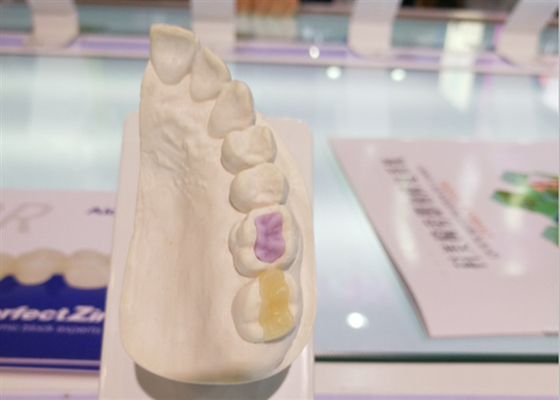 Corona Tutto ceramica di FDA della ceramica dentaria su ordinazione ad alta densità su ordinazione