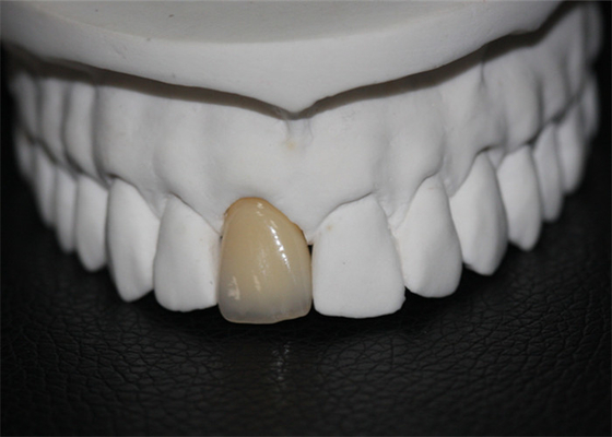 Corona dentaria della porcellana del Cr di Co