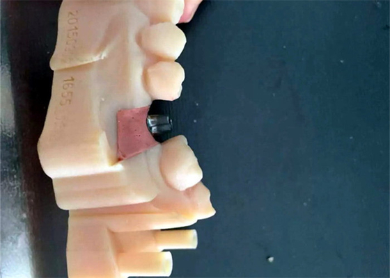 CAD / CAM PFM corone dentali ponte materiale resina buona biocompatibilità stabilità