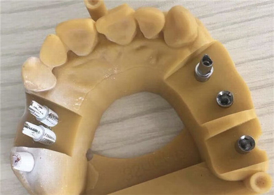 Corona dentaria 3D di biocompatibilità PFM di Digital che stampa le corone temporanee