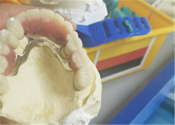 Protesi dentaria durevole flessibile del collegamento di precisione resistente alla corrosione
