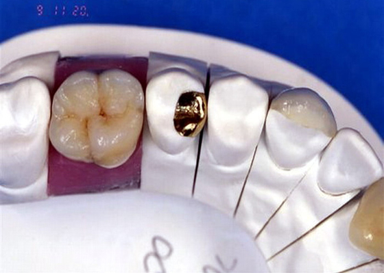 Corona dentaria della porcellana di PFM