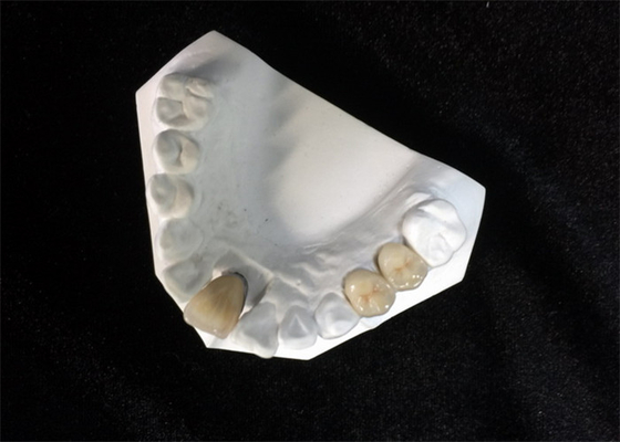 Il dente naturale dell'alta corona dentaria ceramica della stabilità PFM macchia resistente