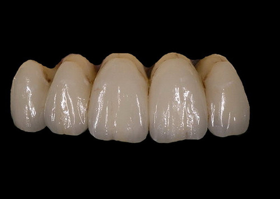 Facile mantenga la stabilità di colore dentaria della corona della porcellana ortodontica di PFM