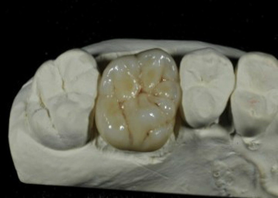 Corona dentaria della porcellana flessibile di iso del CE per ripristino dei denti posteriori